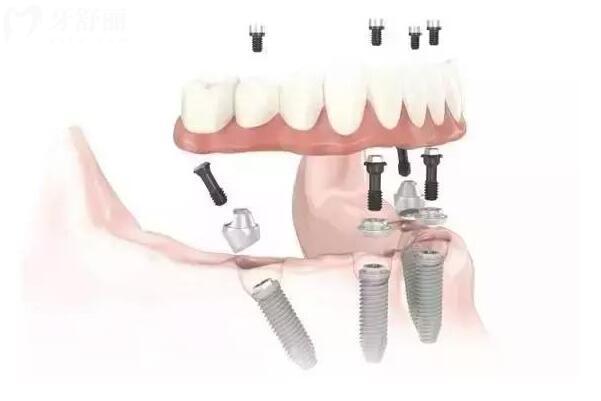 寮步医院牙科价目表2024年,含种植牙/牙齿矫正/根管治疗等收费标准