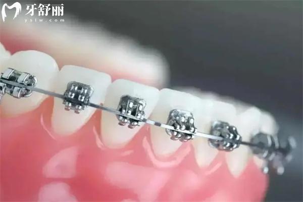 金属矫正牙套