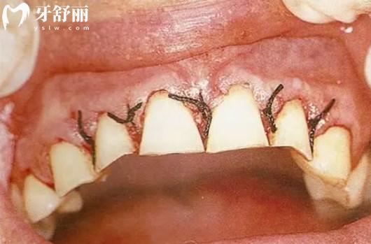 牙龈再生术