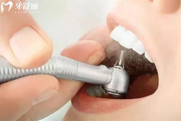 普通洗牙与深度洗牙有什么区别