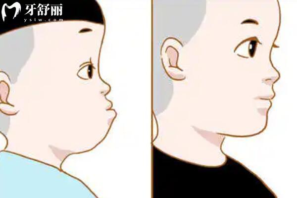 反颌较佳矫正年龄是几岁？反颌的矫正方法有哪些？
