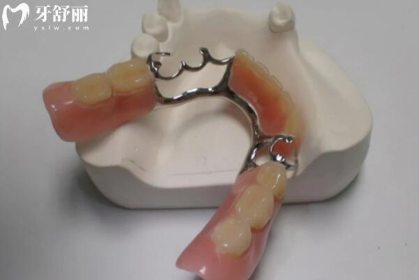 假牙种类对比：哪种修复耐用且使用寿命较长？