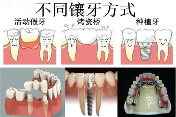 不同镶牙方式