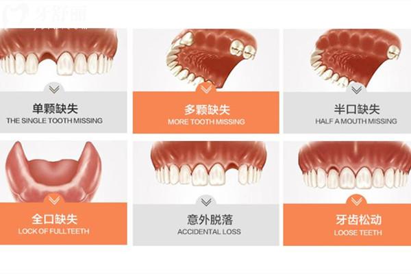 种植牙半口有几种方法