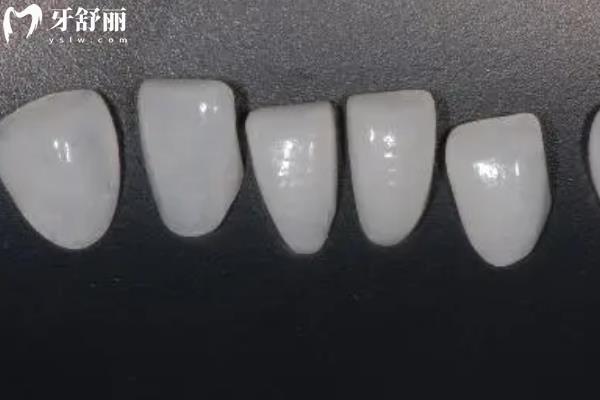 全瓷牙贴面能维持多久
