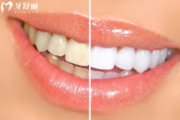 牙齿美白哪种方法好还没副作用