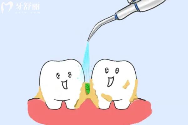 洗牙加喷砂是什么意思