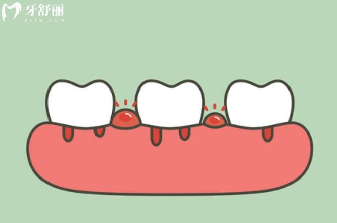 牙齿经常出血用什么牙膏比较好