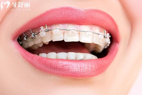 戴牙套里面的牙齿容易坏吗