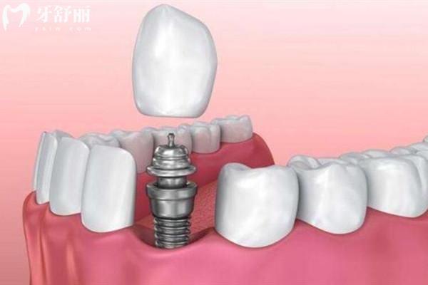贵阳牙博士口腔收费高吗?2025年全新价格一览:种牙/矫正/补牙多少钱 贵阳牙博士口腔收费高吗?2025年全新价格一览:种牙/矫正/补牙多少钱