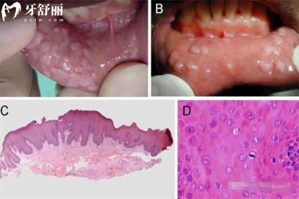 口腔HPV初期症状有哪些