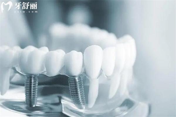 上海做种植牙哪家医院好又便宜?分享前十排名牙科及种植牙收费价目表
