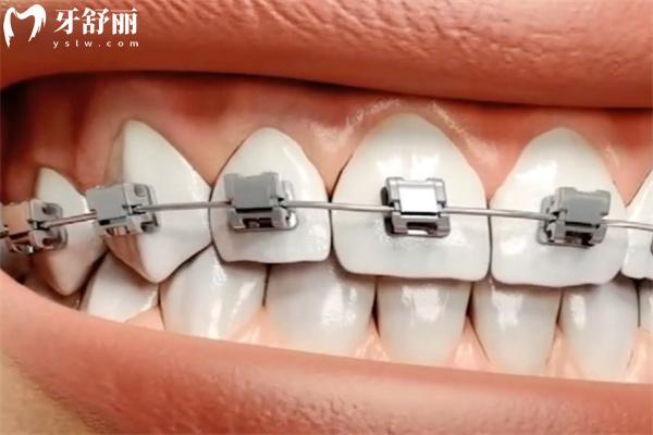 戴金属牙套可以参加高考吗