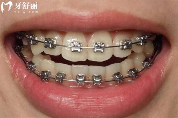 戴金属牙套可以参加高考吗