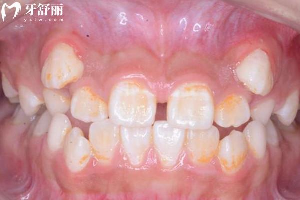 牙齿脱矿是什么原因造成的