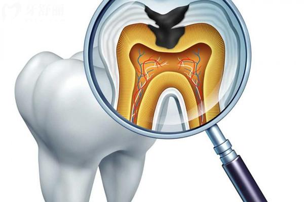 牙齿脱矿是什么原因造成的