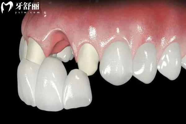 牙齿渗透树脂修复能保持几年时间