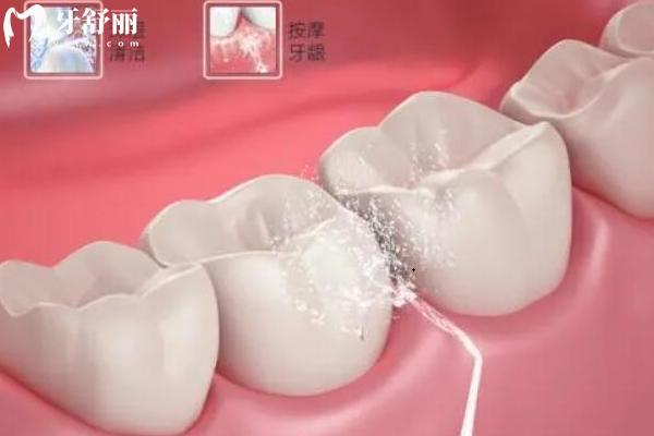 定期洁牙对牙齿有危害吗？牙齿松动？牙缝变大？真相水落石出