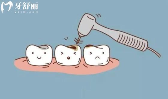 洗牙对牙齿损伤的误解及澄清