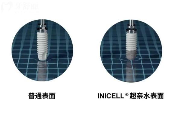 瑞士种植牙品牌排行榜以及价格