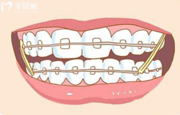 戴牙套有几个阶段？疼不疼？