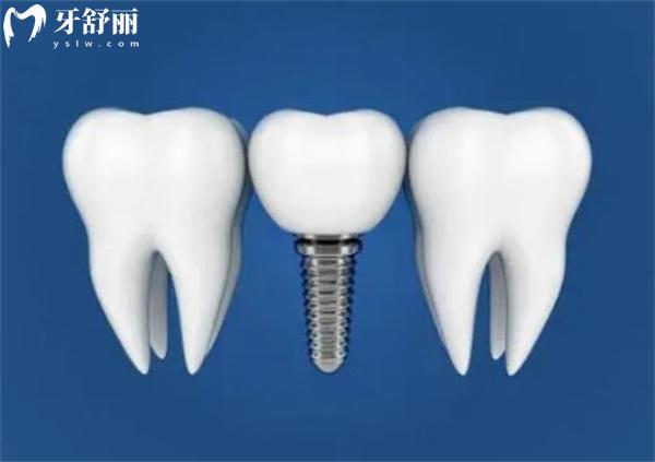微创种植牙的过程技术没有痛苦