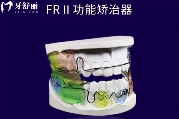 Frankel II矫治器