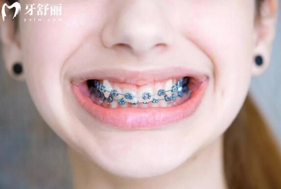 【口腔科普】孩子换牙前,究竟要不要做牙齿矫正？