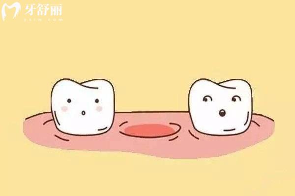 先天性缺牙