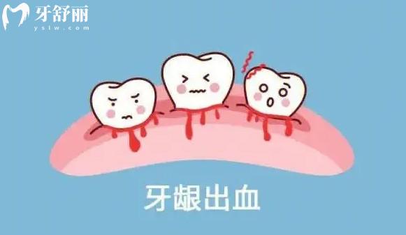 预防牙龈出血的小知识有哪些