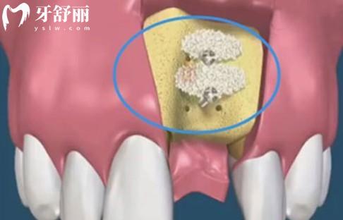 骨粉在牙齿种植中的重要性