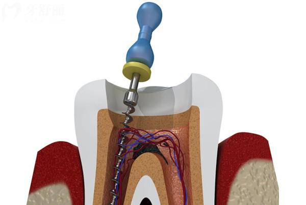 牙齿不疼,为何依然需要根管治疗?深度剖析医生建议原因
