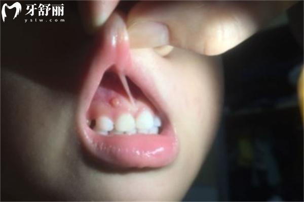 牙龈肿起来一个肉包特别疼一按就出血什么原因？