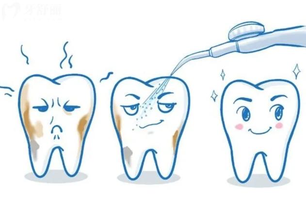 冲牙器能冲掉牙结石吗