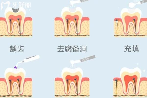 补牙的白色填充物是什么？能坚持多久？附超详细补牙过程