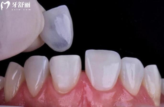 四环素牙怎样才能变白