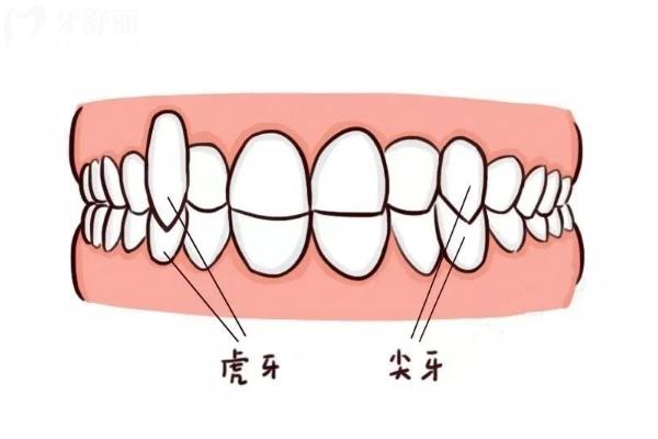 冷知识：虎牙其实是一种牙齿畸形！快让有虎牙的小伙伴来看看