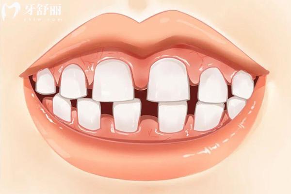 牙齿畸形形成的原因有哪些