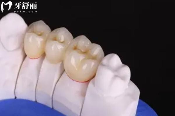 牙洞太大补牙后需要做牙套吗