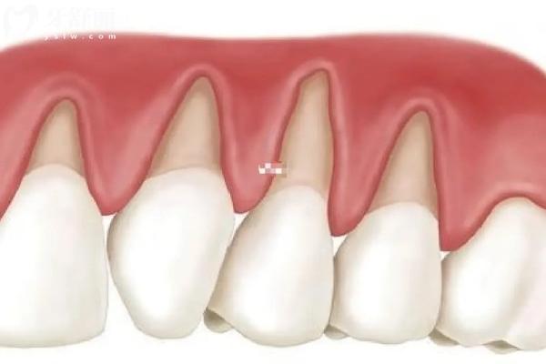 牙龈萎缩和刷牙用力有关系吗?