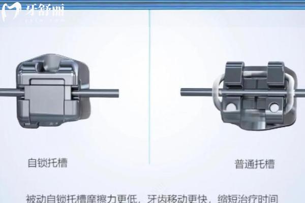 牙套多少钱价格表2024