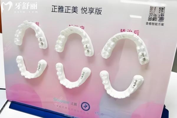 牙套多少钱价格表2024