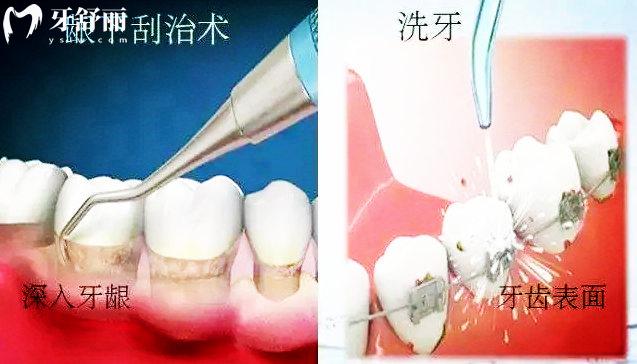 洗牙和牙周刮治的区别