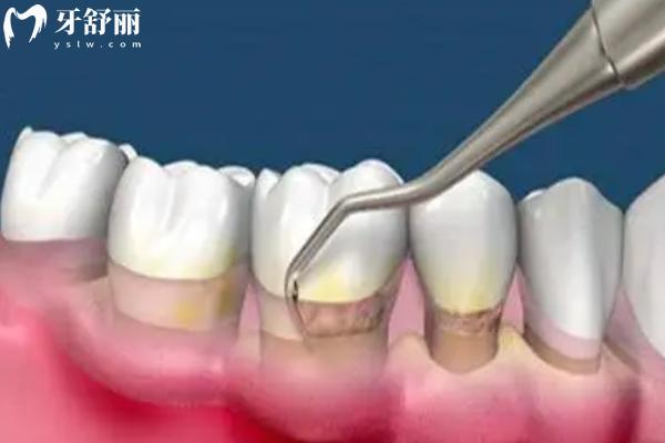 牙周炎一辈子都治不好吗? 牙周炎一辈子都治不好吗?