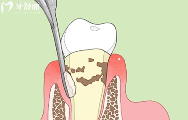 牙根发黑腐烂怎么治疗？看看如何挽救