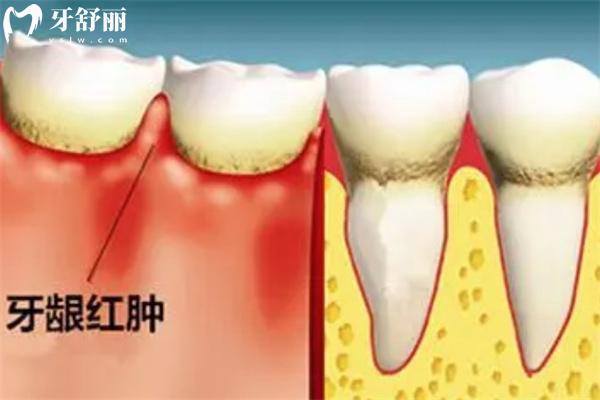 牙周炎图片及症状图片大全