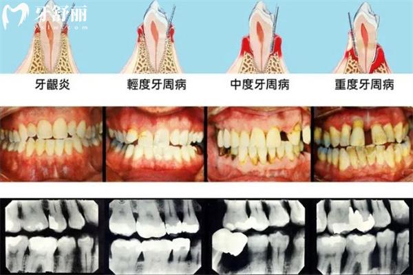 牙周炎图片及症状图片大全