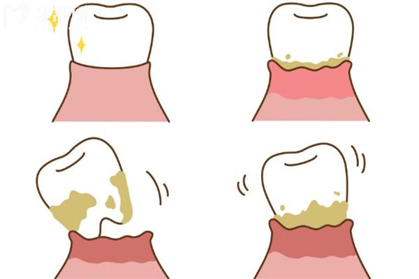 牙周炎图片及症状图片大全