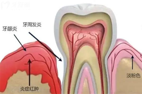 牙周炎图片及症状图片大全