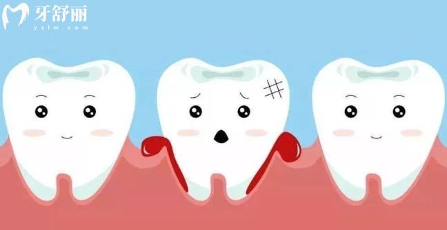 牙周炎会导致年纪轻轻掉牙吗